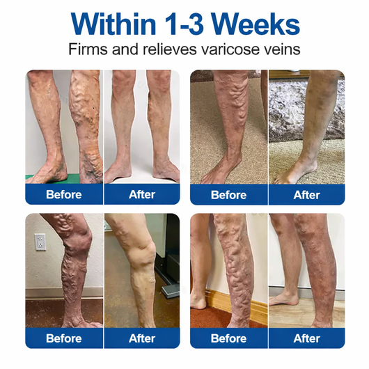 Miasaki VeinTarget Microneedle Patch