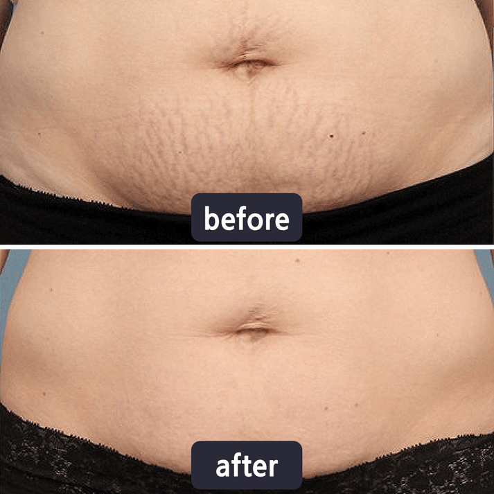 Miasaki Scar Removal Cream