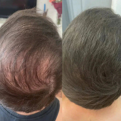 Miasaki Hair Density Filler