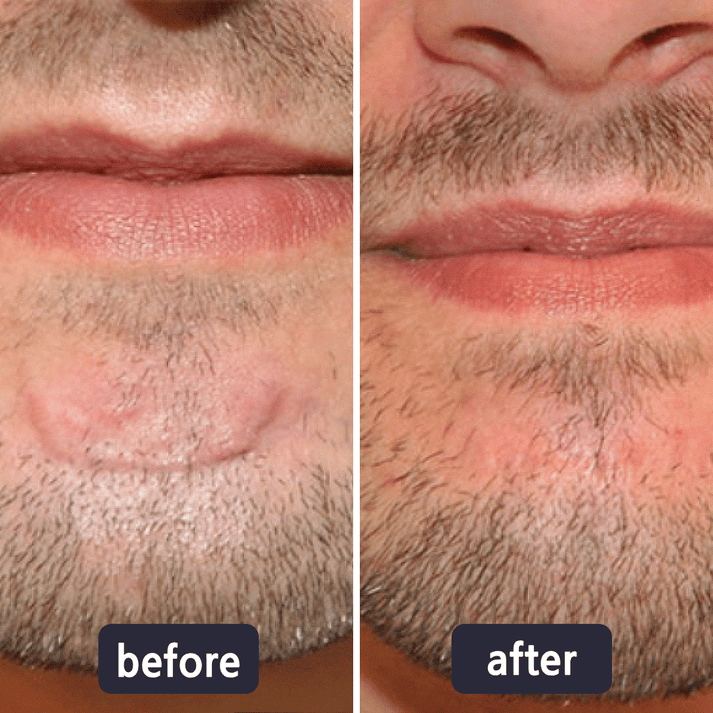 Miasaki Scar Removal Cream